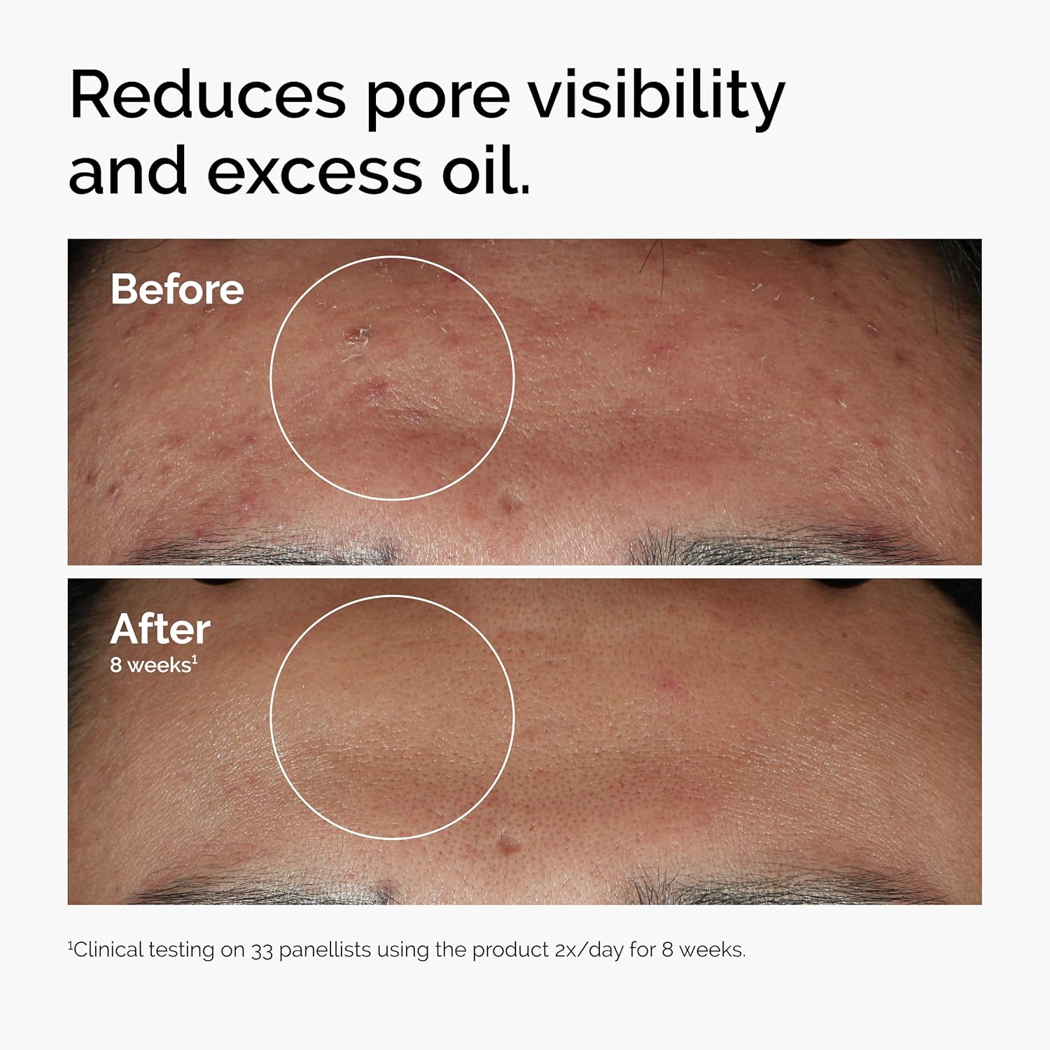 1759526029_The-Ordinary-Niacinamide-10-Zinc-1-Smoothing-Serum-for-Blemish-Prone-Skin.jpg The Ordinary Niacinamide 10% + Zinc 1%, Smoothing Serum for Blemish-Prone Skin - Image 3