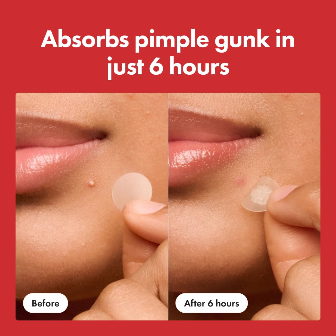 1761379890_Mighty-Patch™-Original-patch-from-Hero-Cosmetics-–-The-1-Hydrocolloid-Acne-Pimple-Patch-for-Shrinking-Zits-and-Whiteheads-in-1-use-Nighttime-Spot-Stickers-for-Face-and-Skin-36-Count.jpg Mighty Patch™ Original patch from Hero Cosmetics – The #1 Hydrocolloid Acne Pimple Patch for Shrinking Zits and Whiteheads in 1 use; Nighttime Spot Stickers for Face and Skin (36 Count) - Image 6