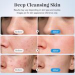 GUGUG Skin Scrubber Face Spatula Skin Spatula Pore Cleaner Blackhead Remover Tools for Facial Deep Cleansing-4 Modes -White - Image 5